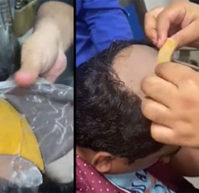 तालु र मलद्वारमा आधा किलो सुन भेटिएपछि…