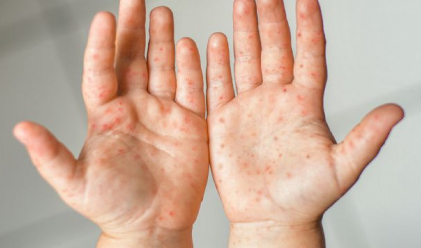 २० देशमा मङ्कीपक्सको सङ्क्रमण, उच्च सतर्कता अपनाउन डब्लूएचओको आग्रह