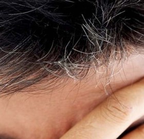 किन कम उमेरमै कपाल सेतो हुने क्रम बढ्दैछ ?