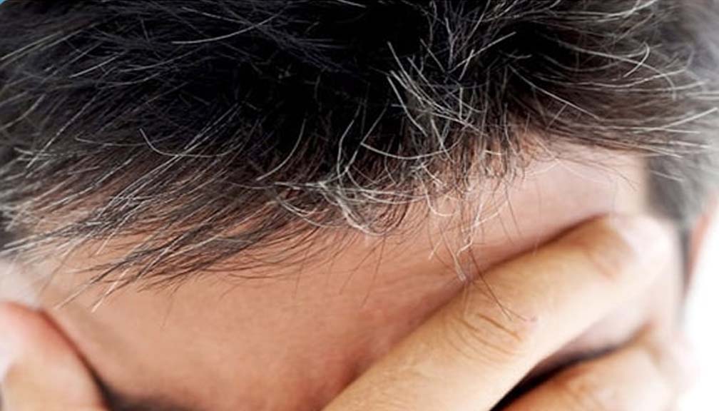 किन कम उमेरमै कपाल सेतो हुने क्रम बढ्दैछ ?