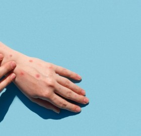 अमेरिकामा १ हजार बढी मानिसमा मङ्कीपक्स सङ्क्रमण