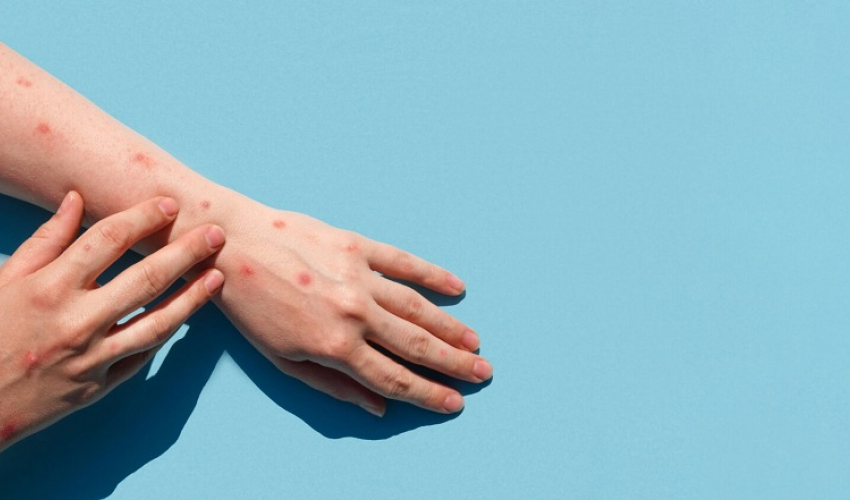 अमेरिकामा १ हजार बढी मानिसमा मङ्कीपक्स सङ्क्रमण