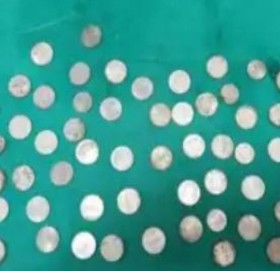 युवकको पेट बन्यो खुत्रुके, शल्यक्रिया गरी निकालियो ६३ सिक्का !