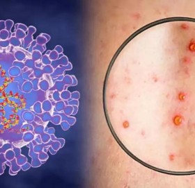 भारतमा मङ्किपक्स भाइरसका सङ्क्रमितको सङ्ख्या ९ पुग्यो