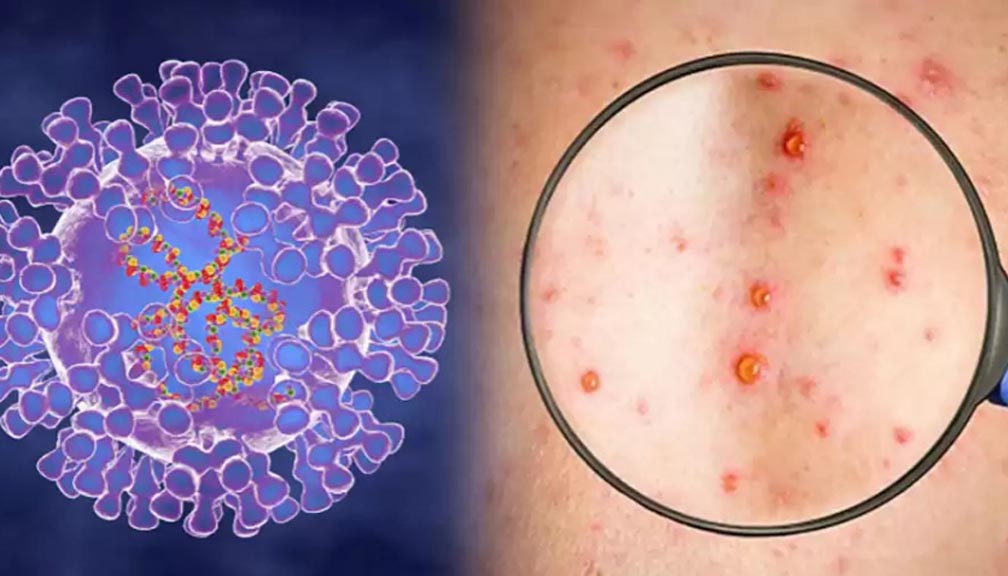 भारतमा मङ्किपक्स भाइरसका सङ्क्रमितको सङ्ख्या ९ पुग्यो