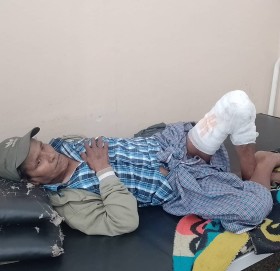 आर्थिक अभाबमा खुट्टा जलेको ५ महिना सम्म पनि उपचार गर्न सकेनन