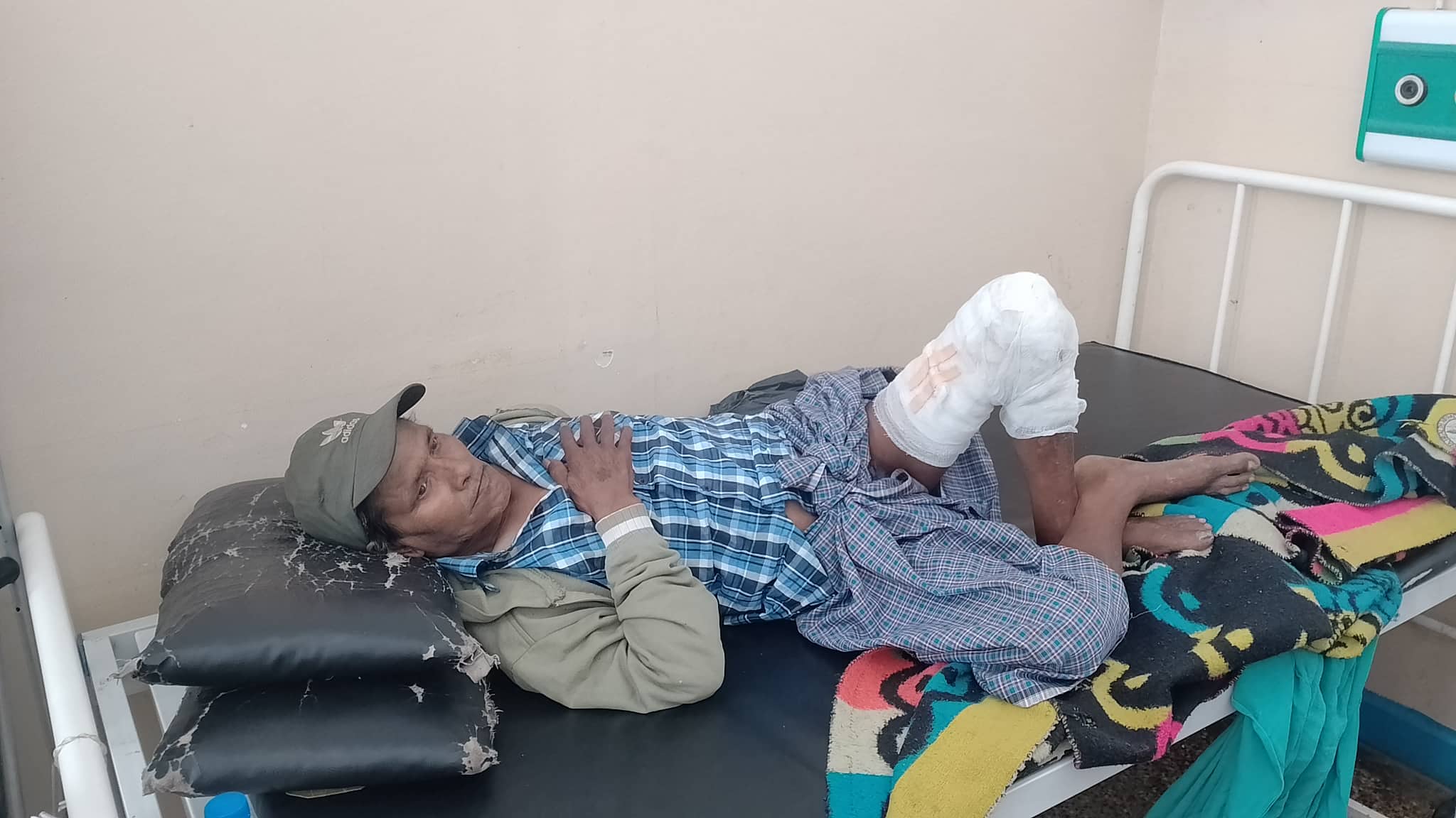 आर्थिक अभाबमा खुट्टा जलेको ५ महिना सम्म पनि उपचार गर्न सकेनन