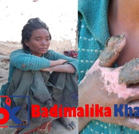 आगोले जलेकी बाजुराकी सुर्पना दमाइ उपचार अभाबमा अलपत्र (भिडीयो सहित)