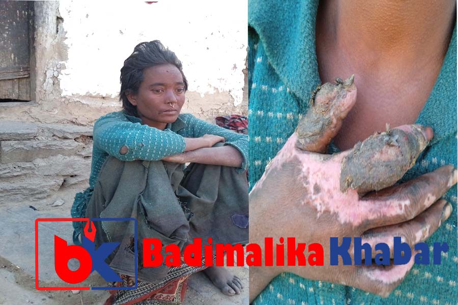 आगोले जलेकी बाजुराकी सुर्पना दमाइ उपचार अभाबमा अलपत्र (भिडीयो सहित)