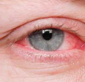 फैलियो आँखा पाक्ने रोग, कसरी बच्ने ?