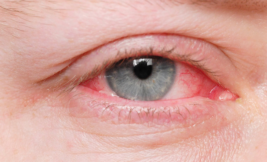 फैलियो आँखा पाक्ने रोग, कसरी बच्ने ?