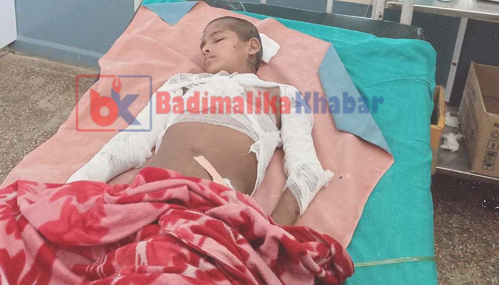 पैसा अभाबमा शरिर जलेका १३ बर्षिय  चरिन्द्र जिवन मरणको दोसाधमा