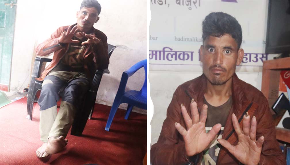 हिमालीका दिल कुष्ठरोग लागेको भन्दै घरपरिवार र समाज बाट तिस्कार