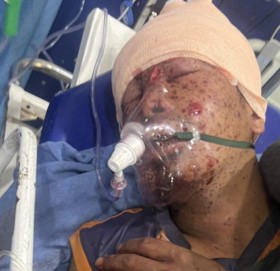 भाँसु भिरमा द्धन्दकालमा राखेको एम्बुस विस्फोट हुदा चार जना घाईते