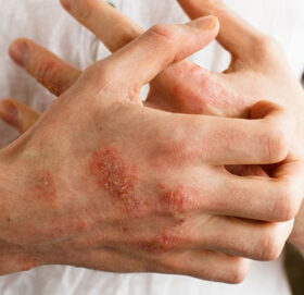 वर्षायाममा छालाको अनेक समस्या, के छ उपचार ?