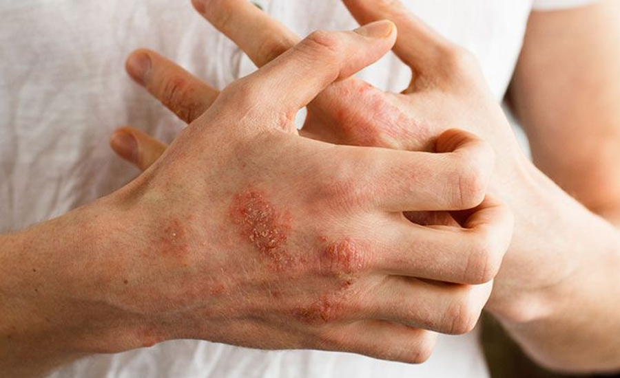 वर्षायाममा छालाको अनेक समस्या, के छ उपचार ?