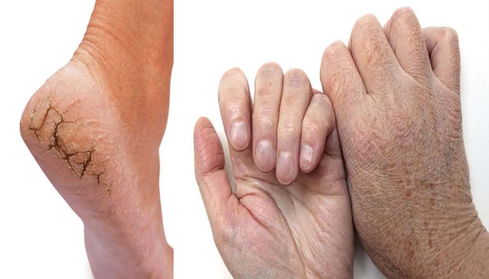 चिसोले हात र खुट्टा फुट्यो ? अपनाउनुस् यी विधि