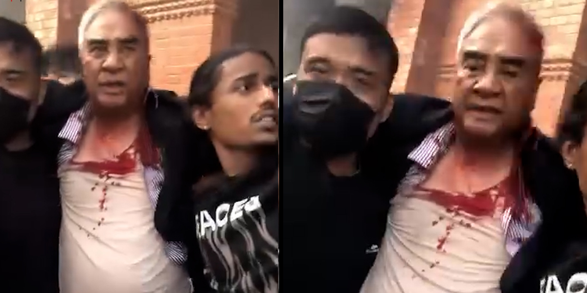 देउवाको टाउकोमा १२ वटा टाँका लगाइयो, केही दिन अस्पतालमै रहने