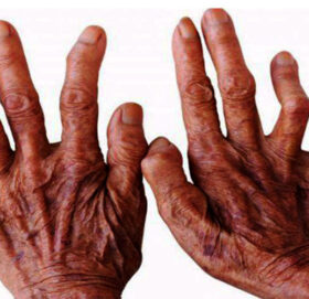 सुदूरपश्चिममा कुष्ठरोगको समस्या यथावत